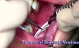 Anterior Maxilla Augmentation with Ramus Autogenous Block Graft - Nikos Mattheos