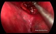 Non Intubated Uniportal VATS Right Upper Posterior Anatomic Segmentectomy S2