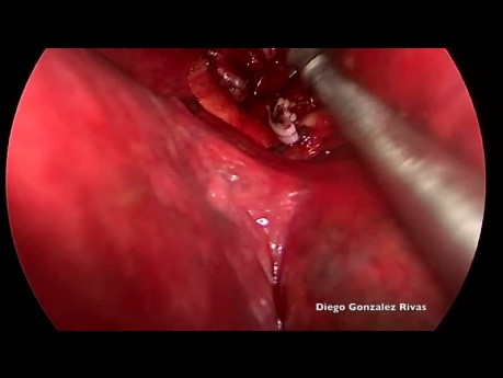Non Intubated Uniportal VATS Right Upper Posterior Anatomic Segmentectomy S2