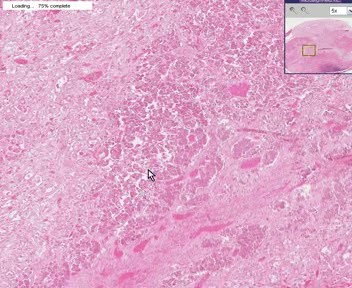 Pituitary - Partial Infarct