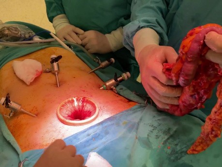 Laparoscopic Extended Right Colectomy