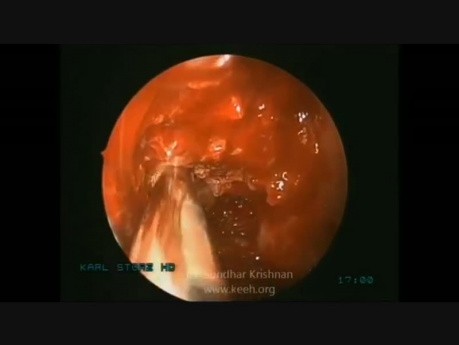 Sinonasal Adenocarcinoma with Intracranial Extension (FESS)