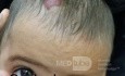 Hemangioma