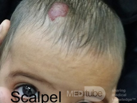 Hemangioma