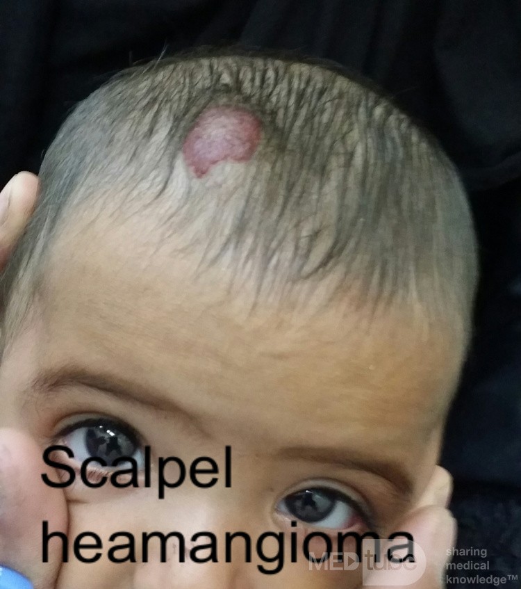 Hemangioma