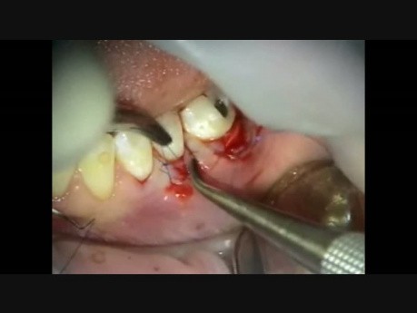 Periodontal Microsurgery - grafting and repair of flap tear