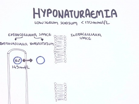 Hyponatraemia (Hyponatremia) - Classification, Causes, Pathophysiology, Treatment