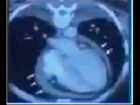 Constrictive Pericarditis Diagnosis, Echocardiography and Treatment