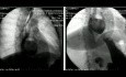 Thoracoscopic Resection of a Large Midd-Esophageal Divertculum Adherent to Aorta and Left Hilum of the Lung