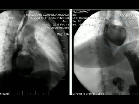 Thoracoscopic Resection of a Large Midd-Esophageal Divertculum Adherent to Aorta and Left Hilum of the Lung