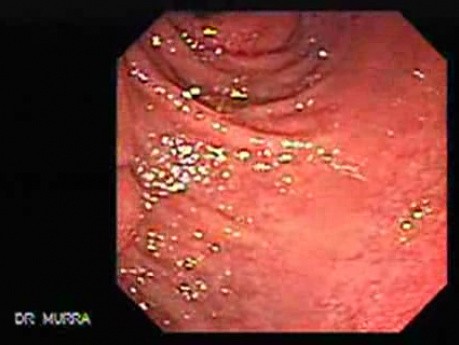 Adenocarcinoma of the Pancreas (2 of 8)