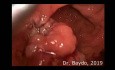 TAMIS for Villous Adenoma of the Rectum