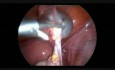 Laparoscopy for Bilateral Cystadenofibroma