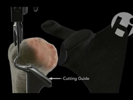Shoulder Hemi-Arthroplasty
