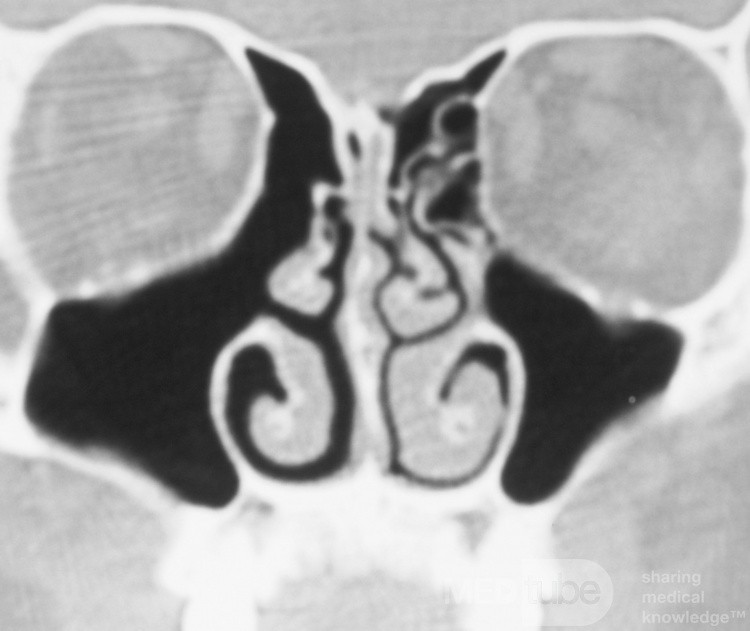 Post endoscopic sinus surgery [right]