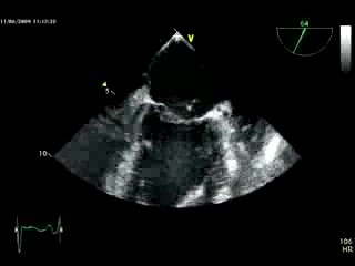 Severe Mitral Regurgitation - TOE - Rupture Chordae