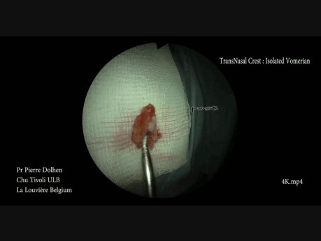 Minimally Invasive Endoscopic Septoplasty