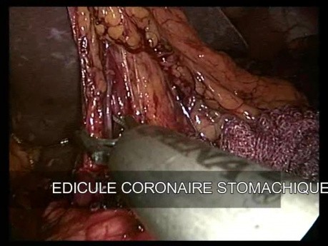 Subtotal Gastrectomy