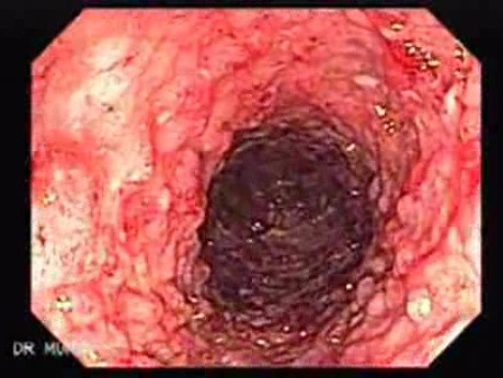 Colitis Ulcerosa - Pseudopolyps (3 of 22)
