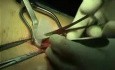 PHS - indirect hernia repair