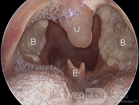 Day 3 Post-Tonsillectomy Bed with Uvula Oedema