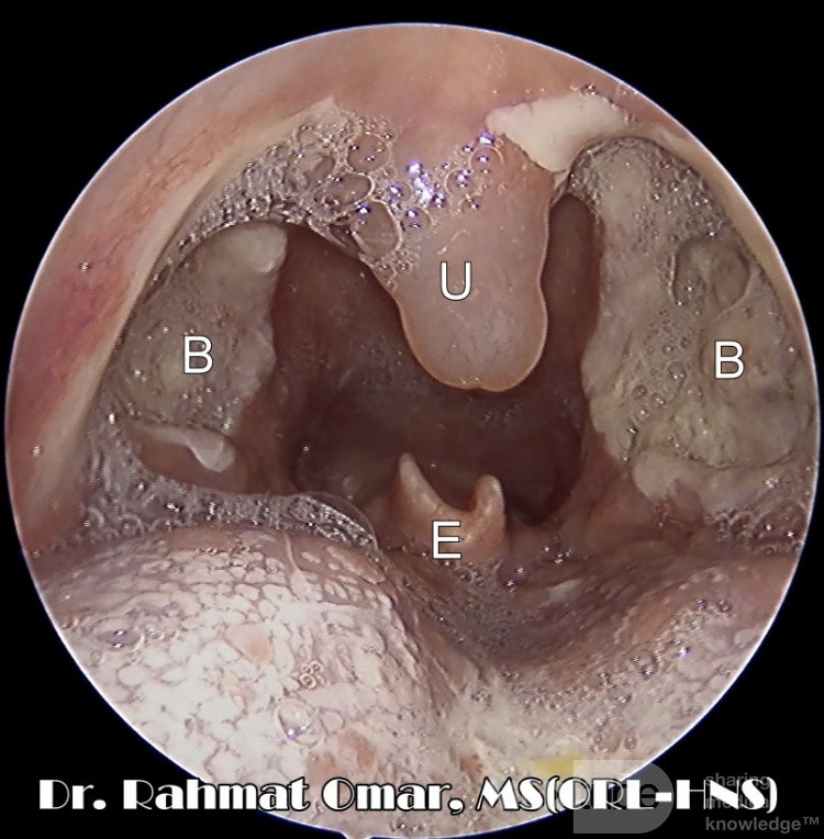 Day 3 Post-Tonsillectomy Bed with Uvula Oedema