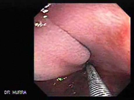 Colonoscopic Polypectomy (8 of 23)