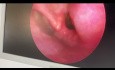 RT Infected Mixed Laryngocele 