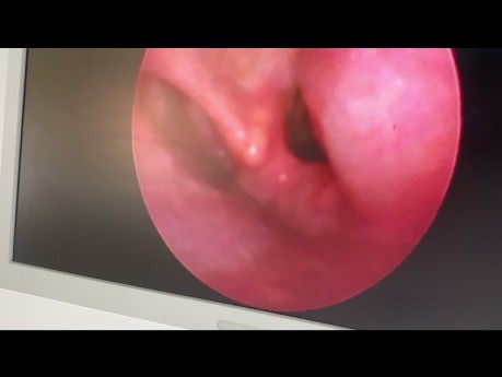 RT Infected Mixed Laryngocele 