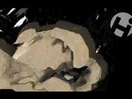 Volumated Feet Fractures