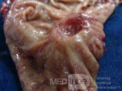 Diffuse Adenocarcinoma with signet ring cells (7 of 18)