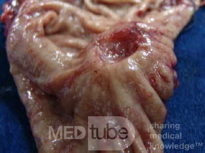 Diffuse Adenocarcinoma with signet ring cells (7 of 18)