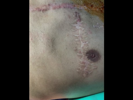 Necessity of Chest Wall Reconstruction for Impediment of Further Trauma 