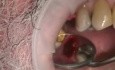 Immediate Implantation After Implant Microsurgery