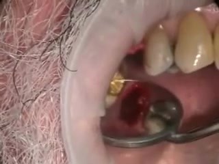 Immediate Implantation After Implant Microsurgery