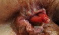 Ulcerated Anterior Mucosal Anal Prolapse