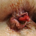Ulcerated Anterior Mucosal Anal Prolapse