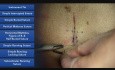 Horizontal Mattress, Figure of 8 and Half Buried - Suture Techniques
