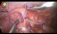 Laparoscopic Appendectomy Using Bipolar Diathermy