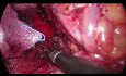 Laparoscopic Median Arcuate Ligament Release - MALS Syndrome