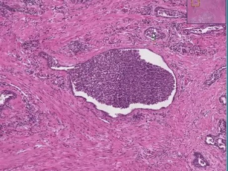prostatitis