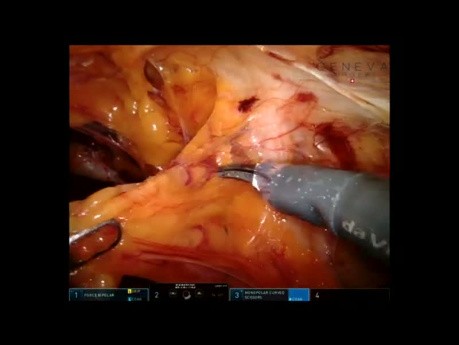 R-TAPP Repair of Female Desincarcerated Right Crural Hernia in Emergency Setting