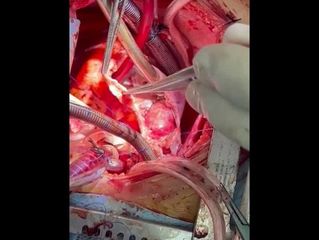 Complex PAPVC Repair with Zeraatian Technique of RA Augumentation Surgery 