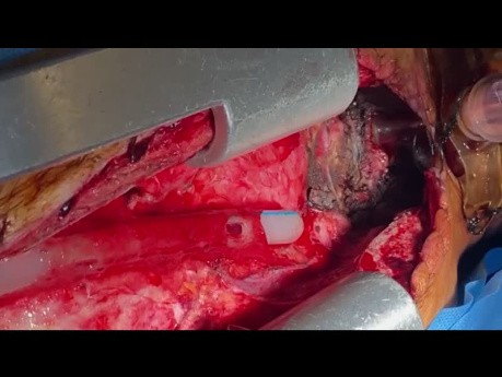 Resection of Tracheal Tumor Recurrence in a Previous Stump Site 