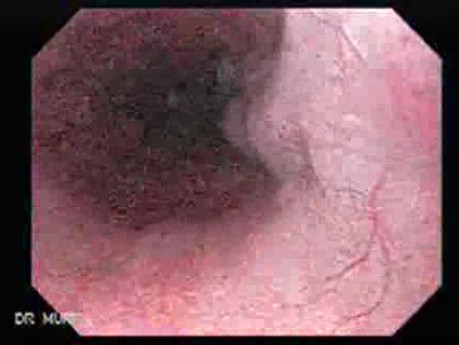 Multiple Gastric Ulcers - Endoscopy (10 of 10)