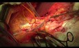 Ovarian Cancer Cytoreductive Operation. Pelvic Part.