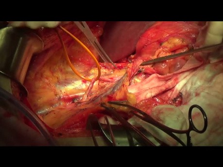 Ovarian Cancer Cytoreductive Operation. Pelvic Part.