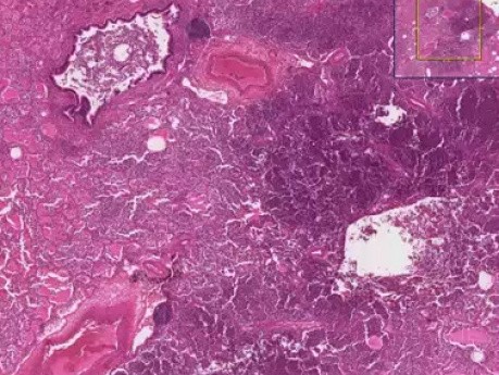 Bronchopneumonia with micro-abscesses - Histopathology - Lung