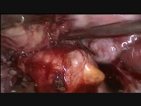 Chocolate Cyst Excision