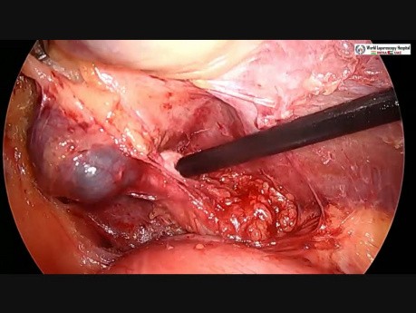 Difficult Laparoscopic Cholecystectomy Performed by Pledget Dissection of Calot's Triangle